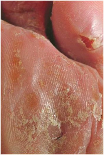 The bottom of afoot infected with tinea pedis (athlete's foot). Although tinea pedis got its better-known name because it is common among athletes, the infection can affect anyone.