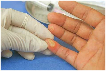 A doctor examines blisters on a person's fingers.