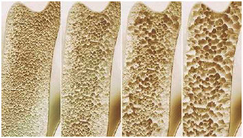 A 3D rendering of the progression of osteoporosis in the bones. Bone loss occurs as people age, so it is important to promote good bone health throughout a person's life.