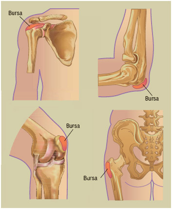 The bursa is a pad-like sac filled with fluid that acts as a lubricant. Inflammation of the bursa (bursitis), which occurs most frequently in the shoulder, elbows, hips, or knees, causes pain during movement.