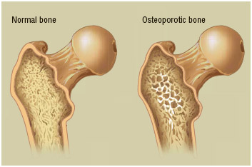 On the left, a healthy bone with normal tissue and density.
