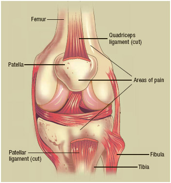 Patellofemoral syndrome (PFS) isa condition involving damage to the cartilage under and around one or both kneecaps. Non-impact or low-impact exercises designed to strengthen surrounding muscles can assist with treatment and prevention.