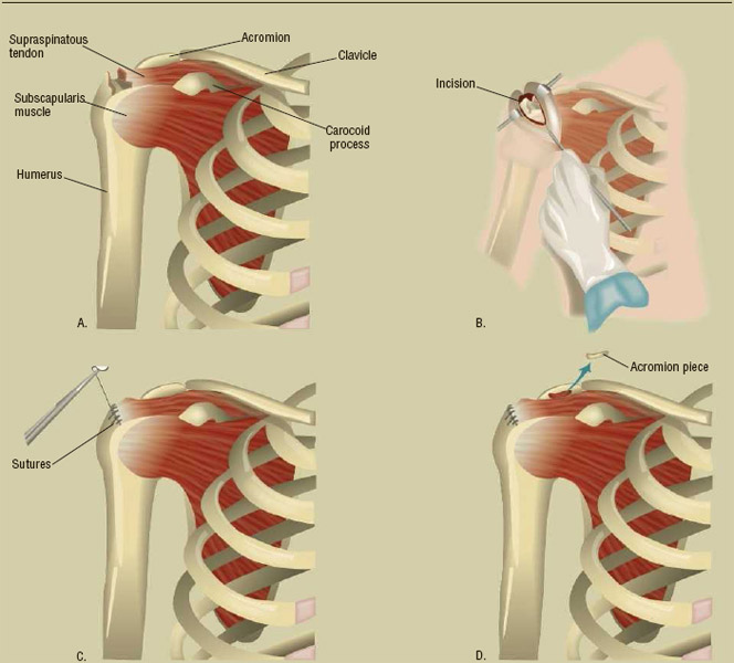 The process of repairing the rotator cuff. Tendons of four muscles comprise the rotator cuff, attaching those muscles to the shoulder blade, upper arm bone (humerus), and collarbone.