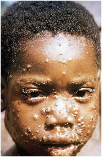 Face of a young boy, who'd sustained the ravages of the characteristic maculopapular monkeypox cutaneous rash. Monkeypox is an infectious disease caused by the monkeypox virus.