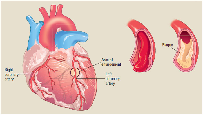 Coronary heart disease is caused by plaque build-up in the arteries.