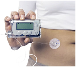 An insulin pump helps deliver a more controlled amount of insulin.