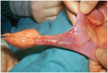 Meckel's diverticulum, is a vestigial remnant of the omphalomesenteric duct (also called the vitelline duct or yolk stalk), and is the most frequent malformation of the gastrointestinal tract.