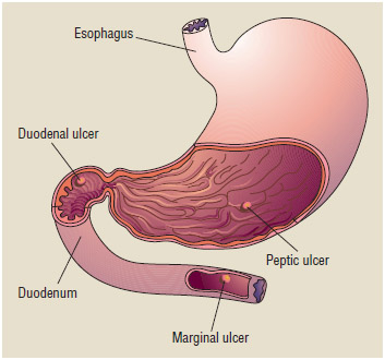 Common sites of ulcers in the human stomach.