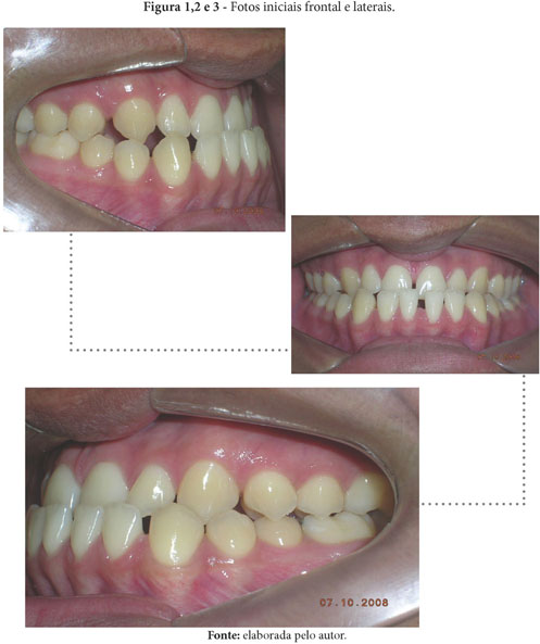 Overjet vs Overbite