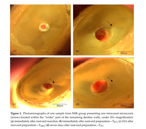 Evaluation Of Root End Preparation With Two Different Endodontic Microsurgery Ultrasonic Tips Document Gale Academic Onefile