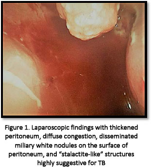 Diagnosis challenges of peritoneal tuberculosis in immunocompetent  patients: case report and short-review of the literature - Document - Gale  OneFile: Health and Medicine