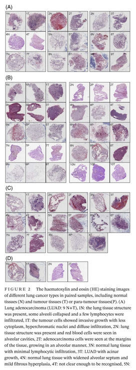 The different functions and clinical significances of caveolin-1 in human  adenocarcinoma and squamous cell carcinoma - Document - Gale OneFile:  Health and Medicine