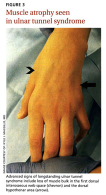 Gale Academic OneFile - Document - Hand compression neuropathy: an ...