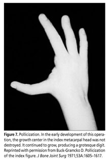 PDF] The prehensile movements of the human hand.