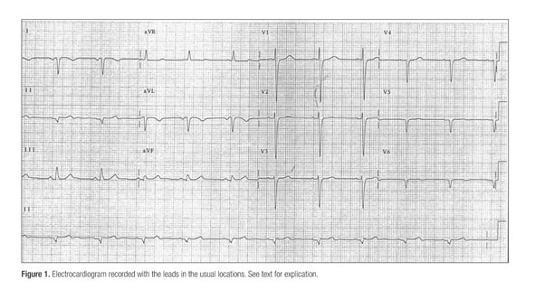 Gale Onefile Health And Medicine Document Electrocardiogram Read By The Computer As Arm Lead Reversal