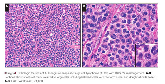 Breast Implant-Associated Anaplastic Large Cell Lymphoma