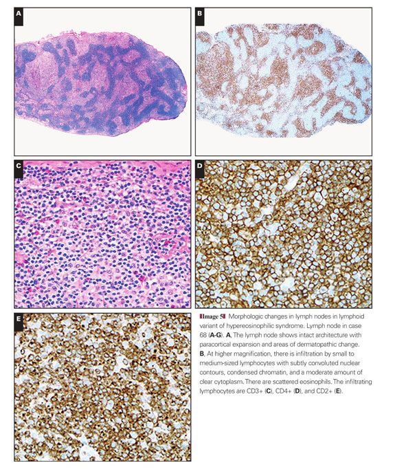 A and B , Hypereosinophilic syndrome. Polymorphic rash with