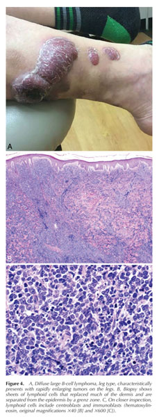 Primary Cutaneous Follicle Center Lymphoma Document Gale Onefile Health And Medicine 