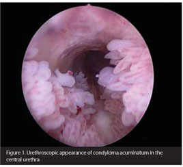 condyloma acuminatum urethra)