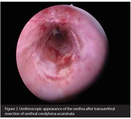 A condyloma urethra tünetei, Papilloma urethrae