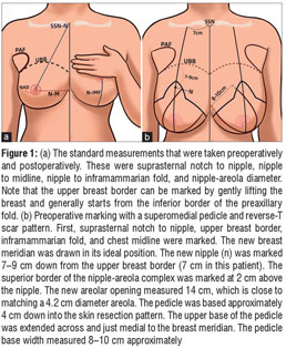 Projection proportion. E: most inferior point of the breast from the