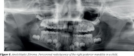 PDF] Peripheral Tumor with Osteodentin and Cementum-like Material in an  Infant: Odontogenic Hamartoma or Odontoma?