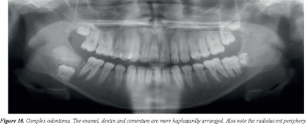 PDF] Peripheral Tumor with Osteodentin and Cementum-like Material in an  Infant: Odontogenic Hamartoma or Odontoma?