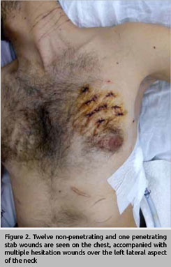 stab wound chest