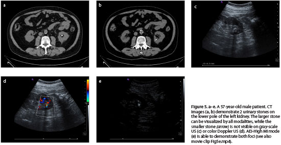 Health Reference Center Academic Document The Usefulness Of Agent Emission Imaging High Mechanical Index Ultrasound Mode In The Diagnosis Of Urolithiasis A Prospective Preliminary Study