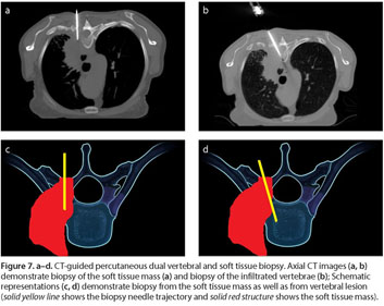 Overcoming CT-to-Body Divergence to Biopsy, Definitively Diagnose and Mark  a Subcentimeter Lesion