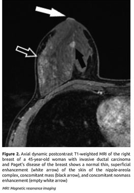 a) Photograph of a woman's breast shows slitlike retraction of the