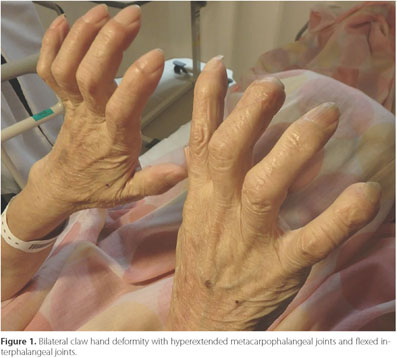 claw finger deformity