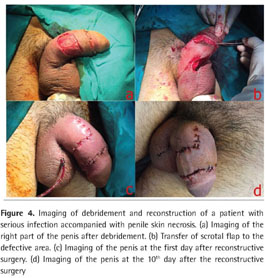 Circumcision with thermocautery technique. a, b) The foreskin was