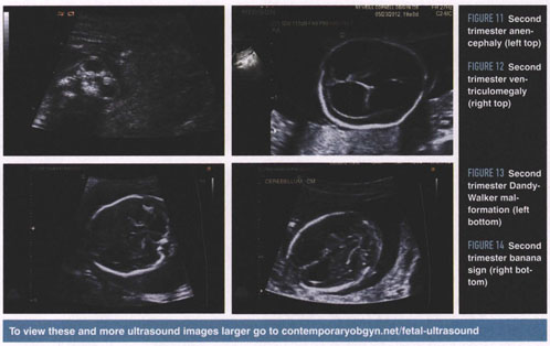 Ultrasound second trimester 2nd Trimester
