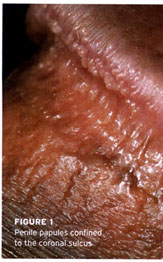 Why do pearly penile papules appear