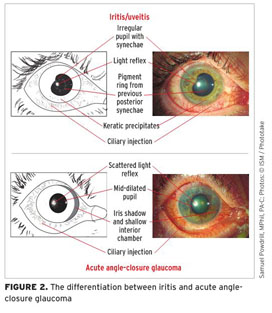 Ciliary injection: a differential diagnosis for the patient with acute ...