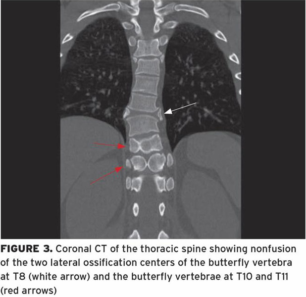 Back Pain Right Sided Weakness And Paresthesia In A Healthy Adult