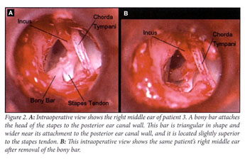 Congenital stapes suprastructure fixation presenting with