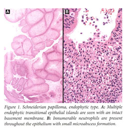Inverted papilloma nasal - Oxiuros donde se encuentran, Do nasal papillomas bleed