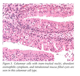 oncocytic nasal papilloma papilloma squamoso lingua cause