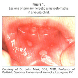 gingivostomatitis in babies