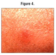 Managing Cutaneous Vasculitis In A Patient With Lupus Erythematosus