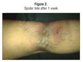 Figure 2 from Rare case of dermonecrosis caused by a recluse spider bite in  Europe