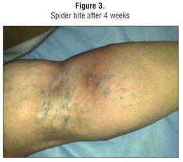 Figure 2 from Rare case of dermonecrosis caused by a recluse spider bite in  Europe