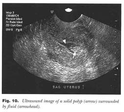 How useful is ultrasound to evaluate patients with postmenopausal bleeding?  - Document - Gale Academic OneFile