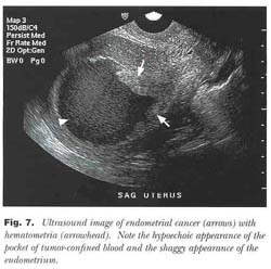 How useful is ultrasound to evaluate patients with postmenopausal bleeding?  - Document - Gale Academic OneFile