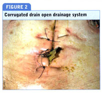surgical wound drains