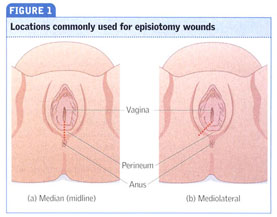 Granulation tissue after episiotomy