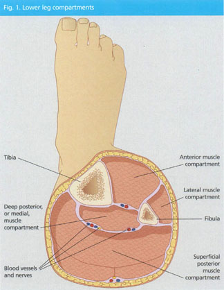 Compartment syndrome of the lower leg