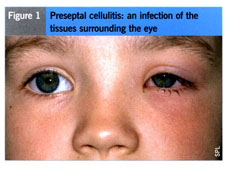 periorbital cellulitis infant